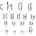 FIGURE 3: Giemsa-banded chromosomes showing karyotype of patient’s  (Case 9)  mother with translocation between the long arm of chromosome 22 and the short arm of chromosome 9 (arrows). 